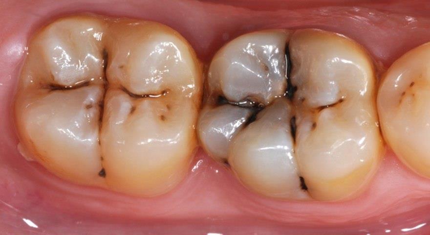پوسیدگی دندان را با این روش تجربه کنید
