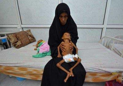 هشدار یونیسف درباره سوءتغذیه حاد در یمن