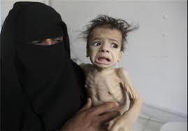 یونیسف: 370 هزار کودک یمنی در معرض سوء تغذیه شدید قرار دارند