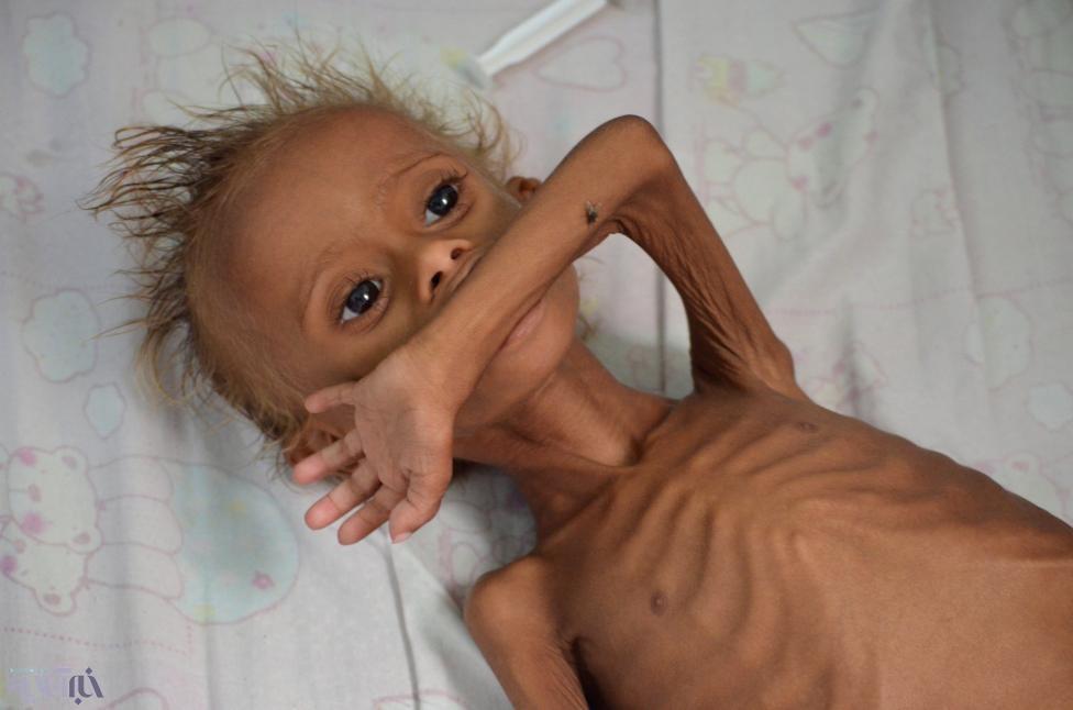 تصاویر | چهره‌های دردناک | جنگ با کودکان یمنی چه کرد؟