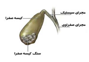 خطر سنگ کیسه صفرا در زنان بیشتر از مردان