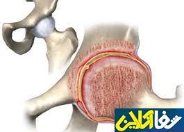 کاهش خطر سائیدگی مفصلی با مصرف فیبر بیشتر