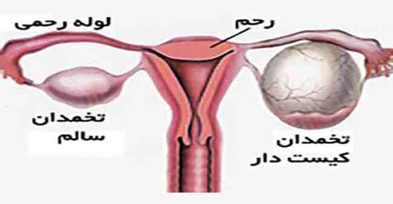 درمان کیست تخمدان به روش طب سنتی