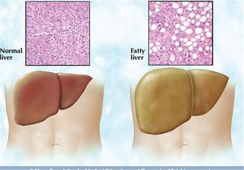 تدابیر طب سنتی برای درمان کبد چرب