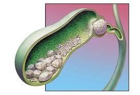 چاقی و کم تحرکی از عوامل ایجاد سنگ کیسه صفرا